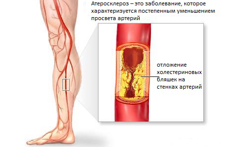 Методы лечения атеросклероза нижних конечностей