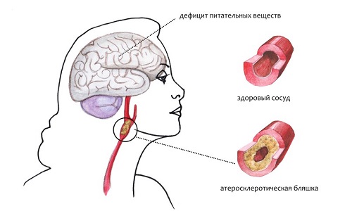 Виникнення і лікування церебрального атеросклерозу судин головного мозку