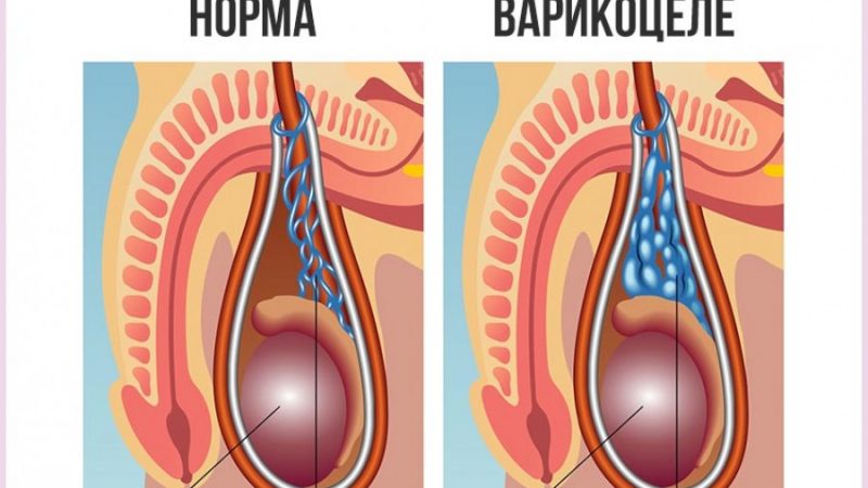 Як робиться операція з видалення варикоцеле на яєчку