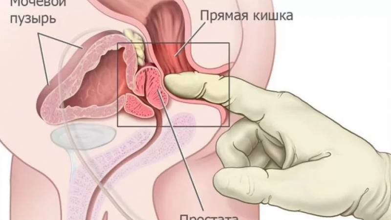 Чим корисний масаж простати — користь і шкода