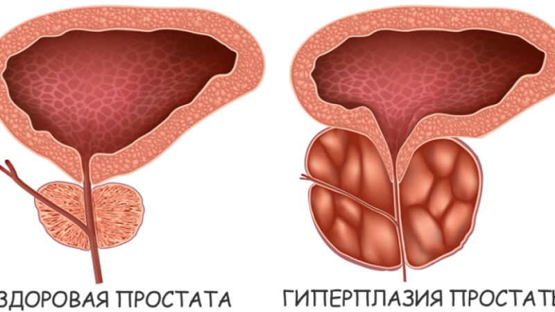 Що таке ДГПЗ передміхурової залози. Покрокове лікування і симптоми
