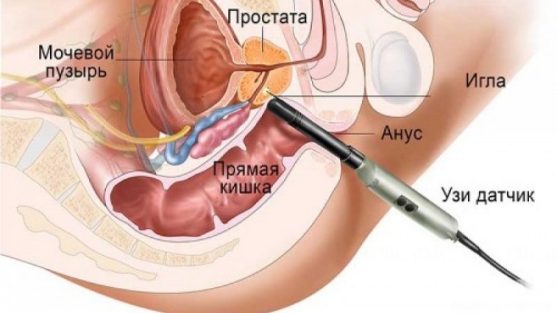 Як проводиться біопсія передміхурової залози (простати)