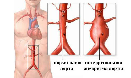 Причини і лікування аневризми черевної аорти