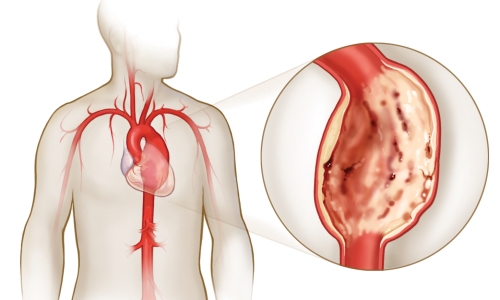 Симптоми та діагностика аневризми аорти